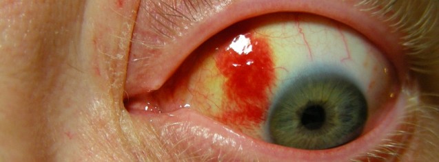 Bloodshot eye